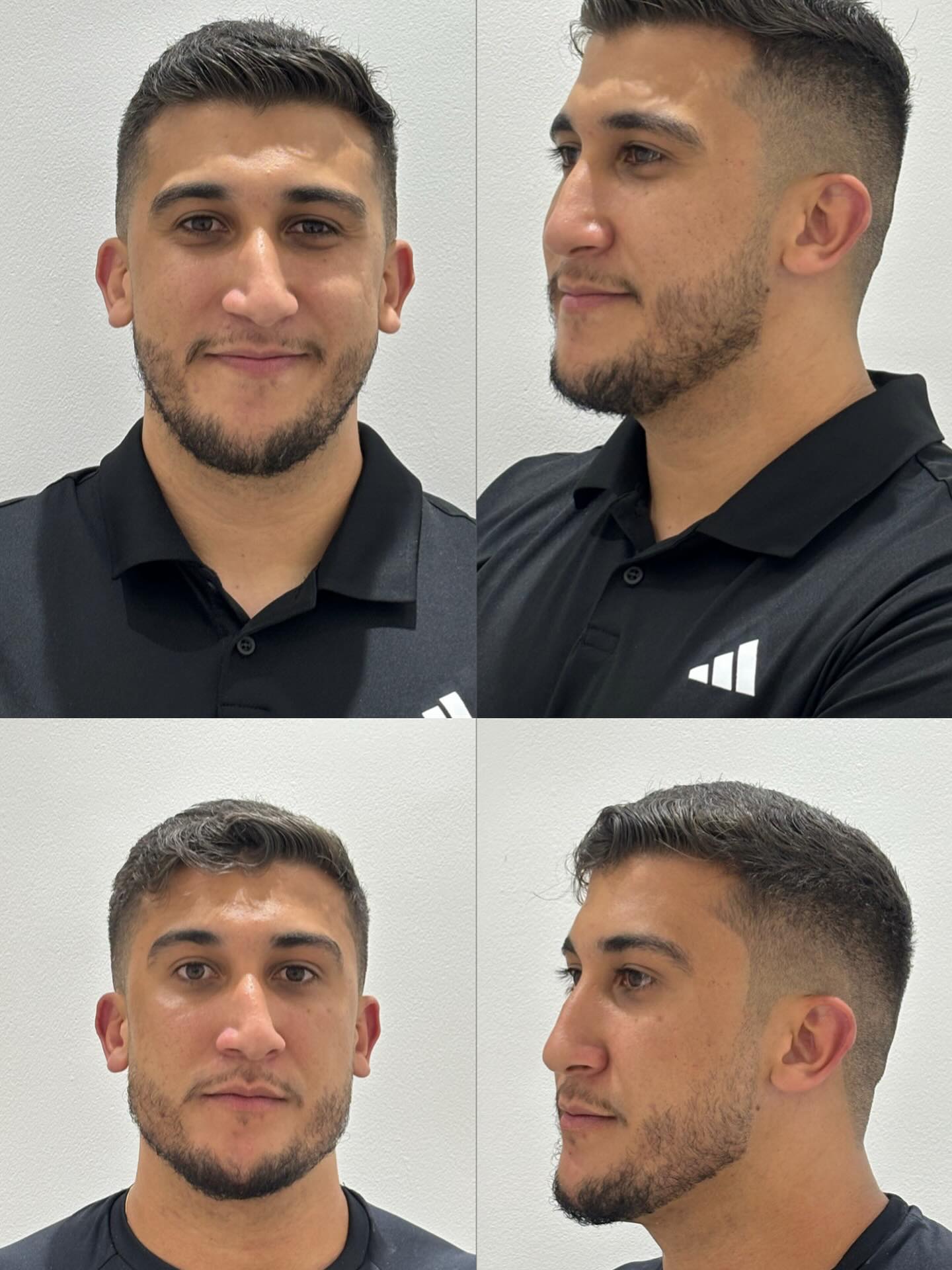 Harmonização Masculina