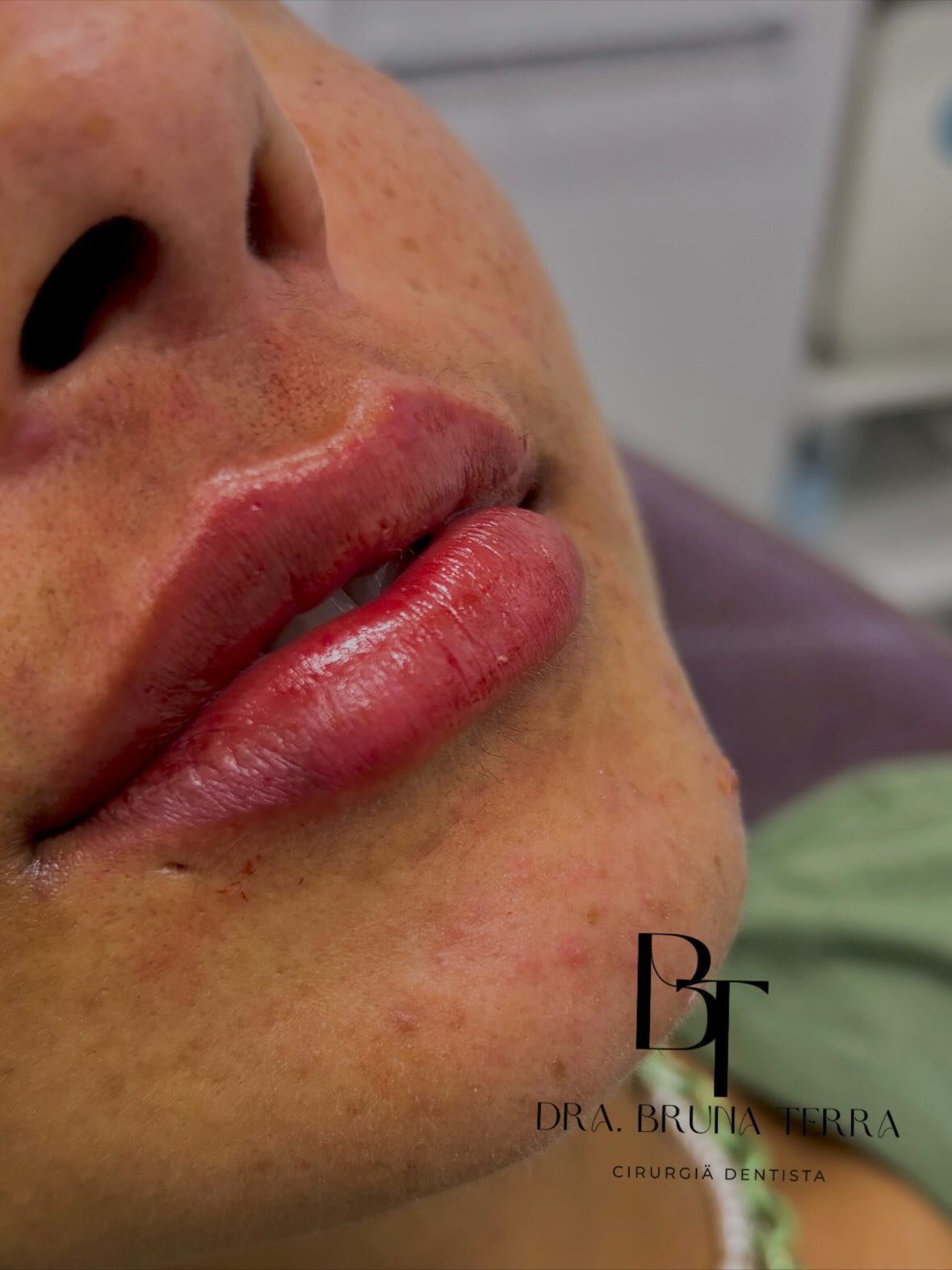 Preenchimento Labial