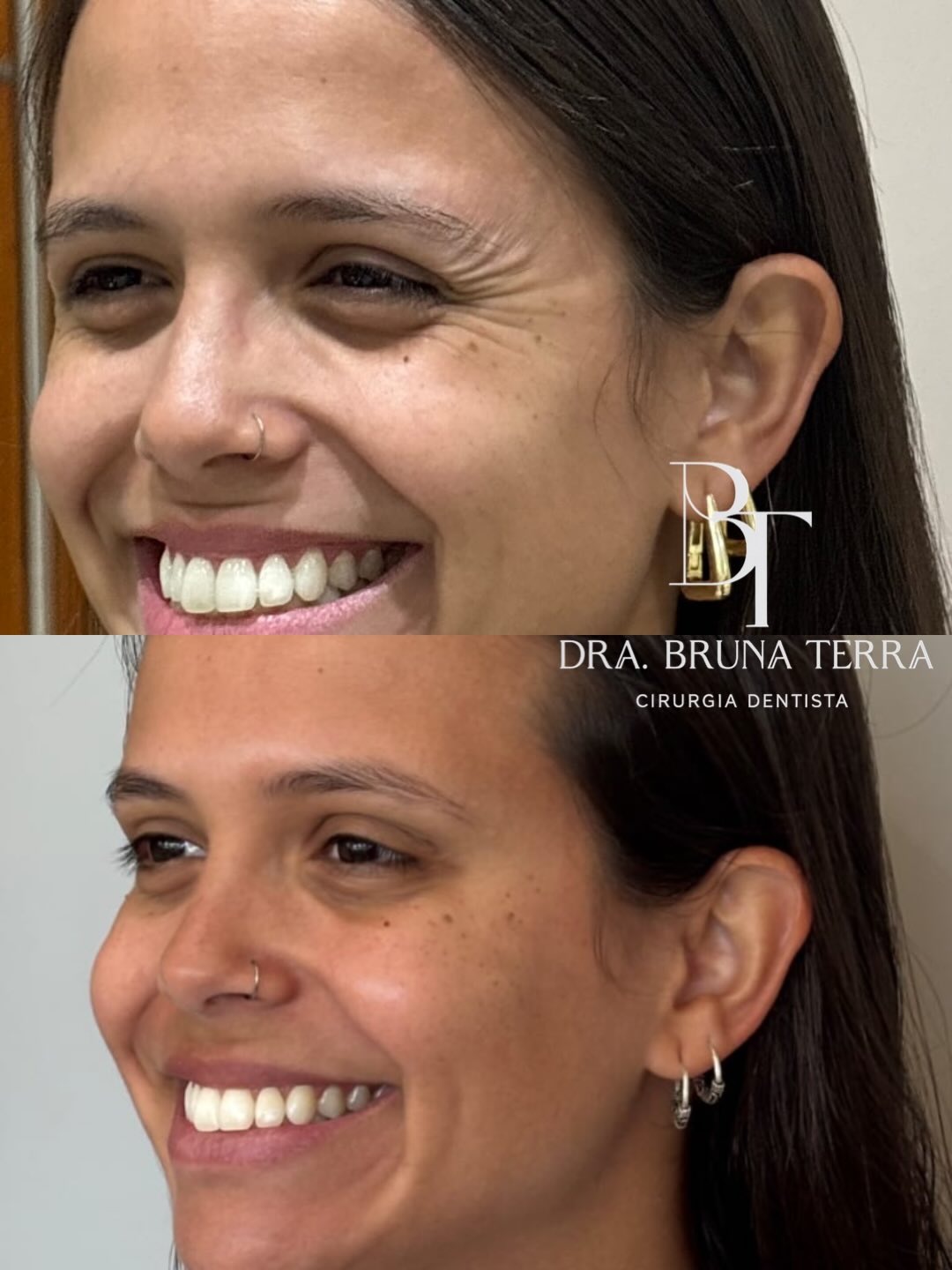 Tratamento de Rugas
